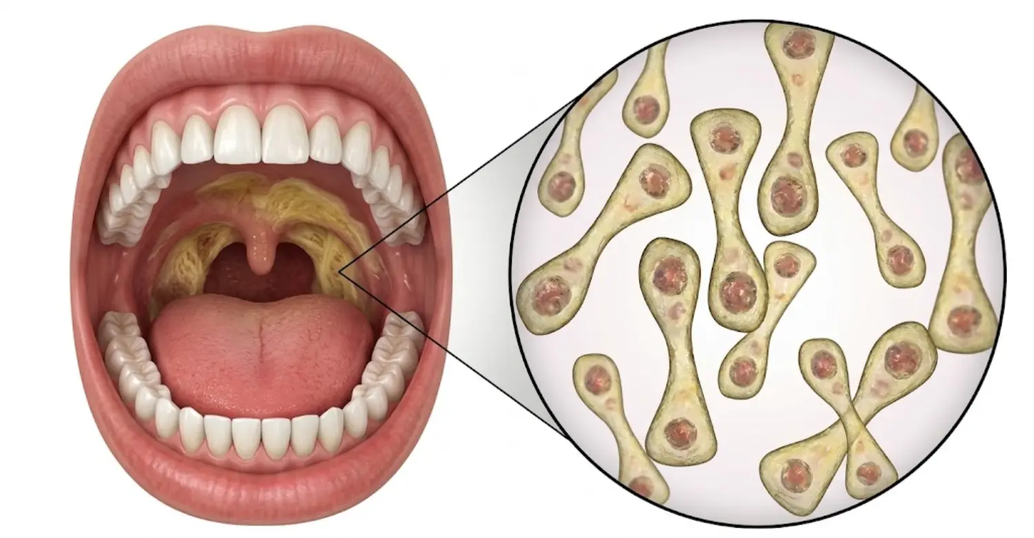 Diphtheria and Oral Health 2